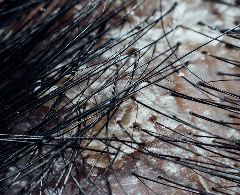 Dandruf And Dry Scalp