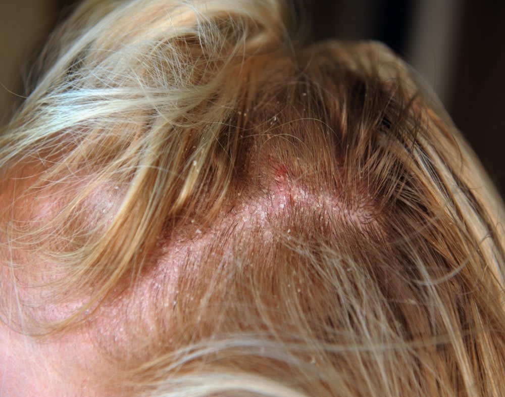 Scalp Inflammation